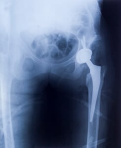A Stryker Hip lawsuit is based on a defective medical hip implant