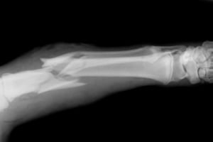 Broken forearm bone x-ray