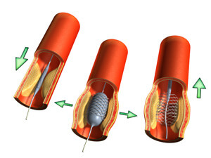 stent in the heart