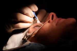 Lasik eye surgery malpractice