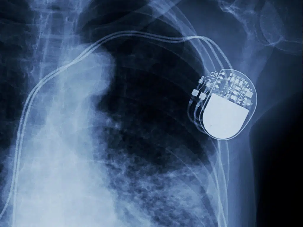 Pacemaker shown in X-ray image